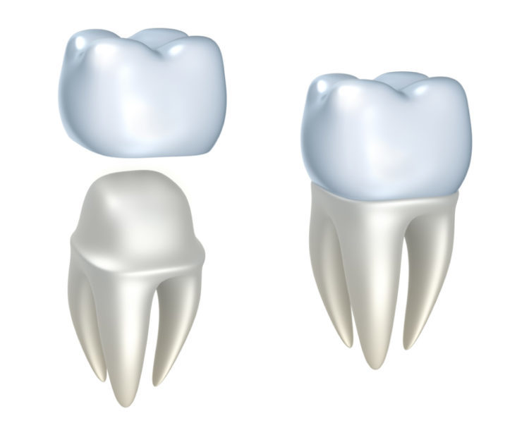 Diagram of a dental crown placed onto a tooth