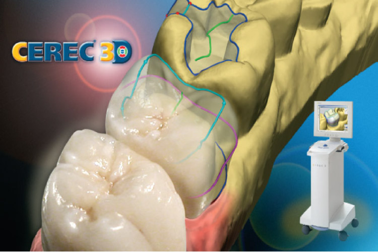 cerec on visit crowns dental technology