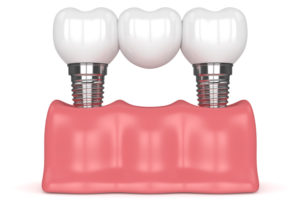 Closeup of a dental bridge made of 2 dental implants