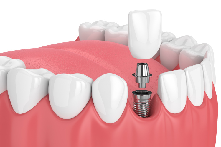 Close-up of a bottom jaw with a dental implant, abutment and dental crown