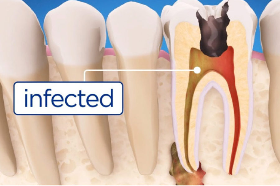 model of an infected tooth root requiring root canal therapy