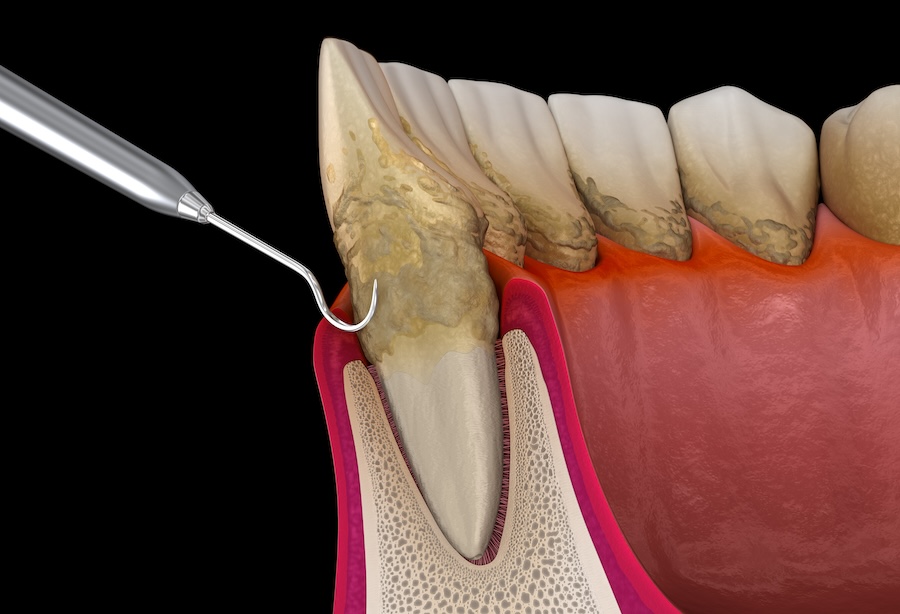 deep cleaning, Non-Surgical Periodontal Therapy, NSPT, gum disease treatment, scaling and root planing, SRP, periodontal disease, dental care College Station TX, Hooks Family Dentistry, Dr. Ryan Hooks, oral health maintenance